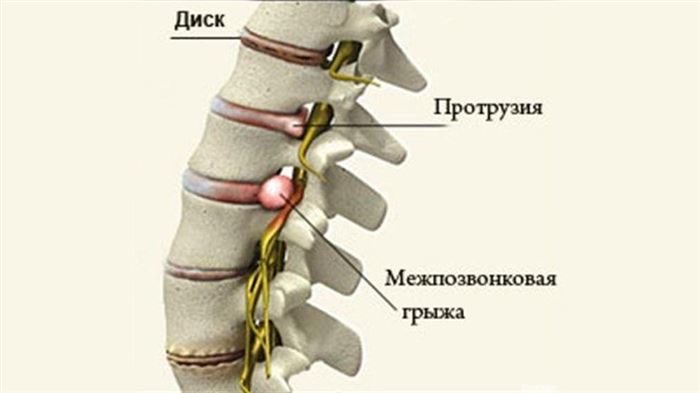 Протрузия, грыжа и хондроз — профильные заболевания инкассаторов. Фото © helportoped.ru